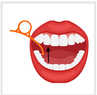 Lower Aligner Removal