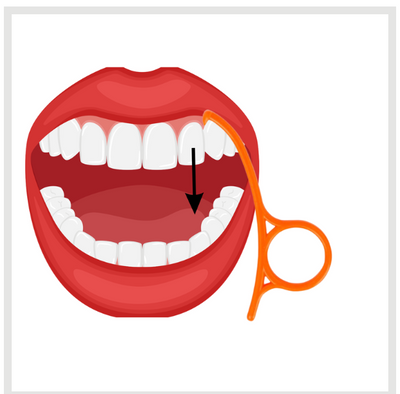Upper Aligner Removal